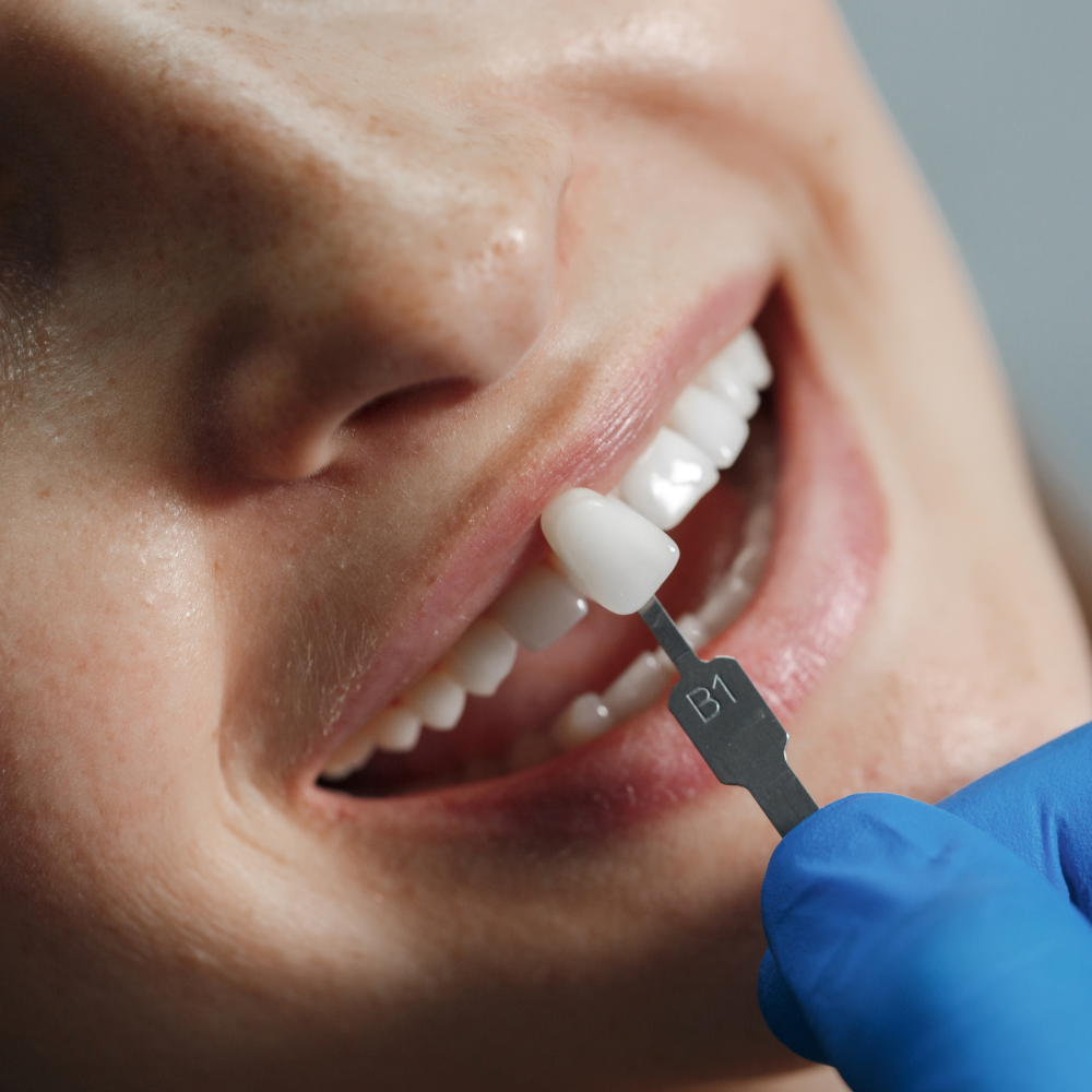Lentes de contato dental em resina: seu novo sorriso está mais perto (e acessível) do que você imagina!