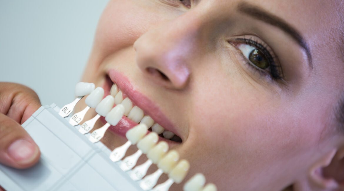 Lentes de contato dental: o segredo dos sorrisos perfeitos de cinema!